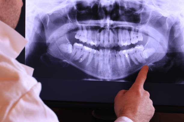 Best Emergency Root Canal Treatment in Brownstown, IN